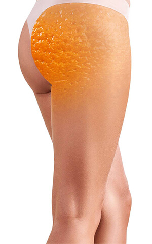 ¿Cómo combatir la celulitis?