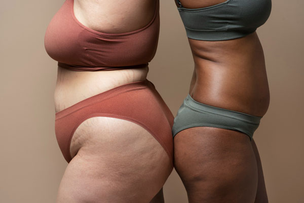 dos mujeres con celulitis